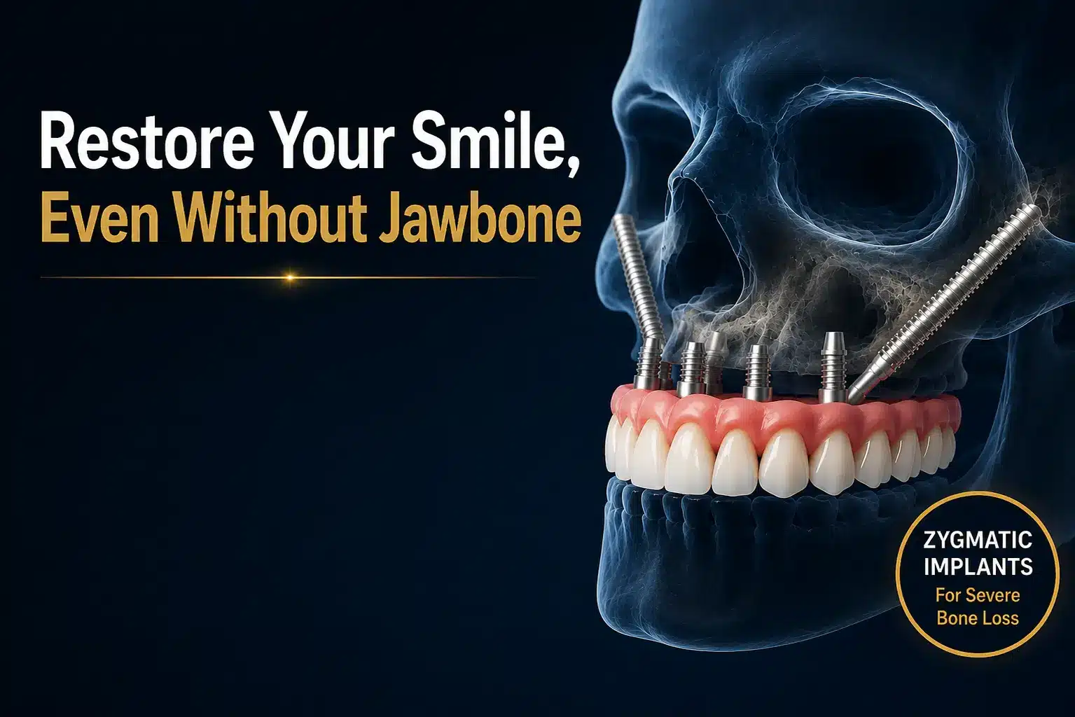 Zygomatic Dental Implants