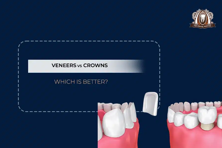 veneers vs crowns