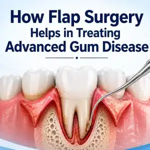 How Flap Surgery Helps in Treating Advanced Gum Disease