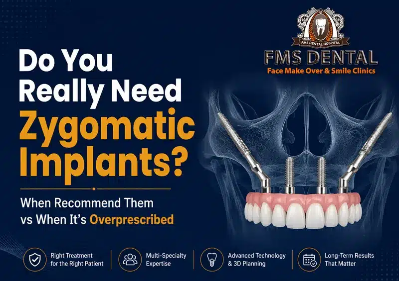 Do You Really Need Zygomatic Implants? When Recommend Them vs When It’s Overprescribed