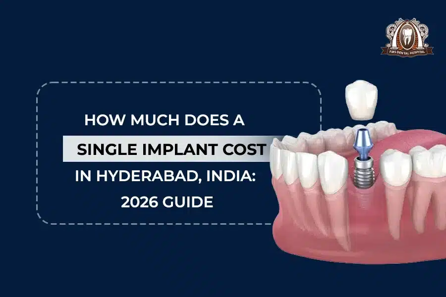 A Single Implant Cost In Hyderabad