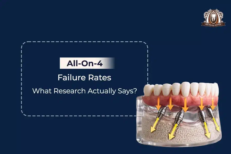 All-On-4 Failure Rates. What Research Actually Says