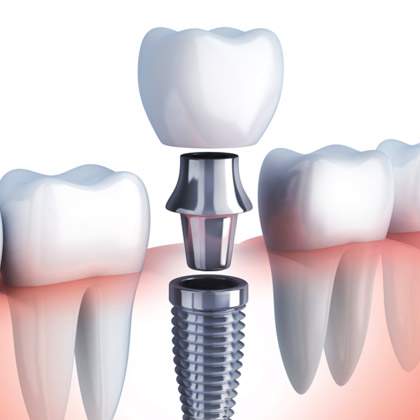 Single tooth dental implant in hyderabad, india