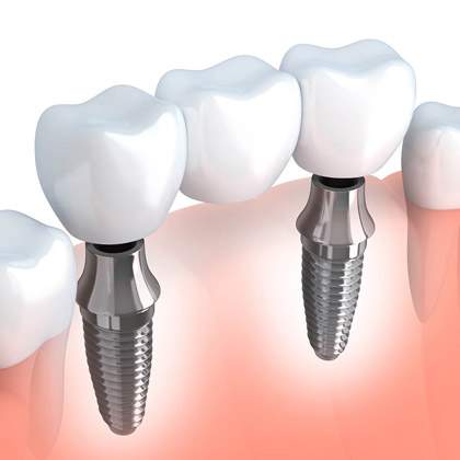 Multiple teeth replacement in hyderabad
