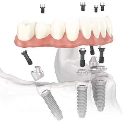 All-in-four dental implant in hyderabad, india