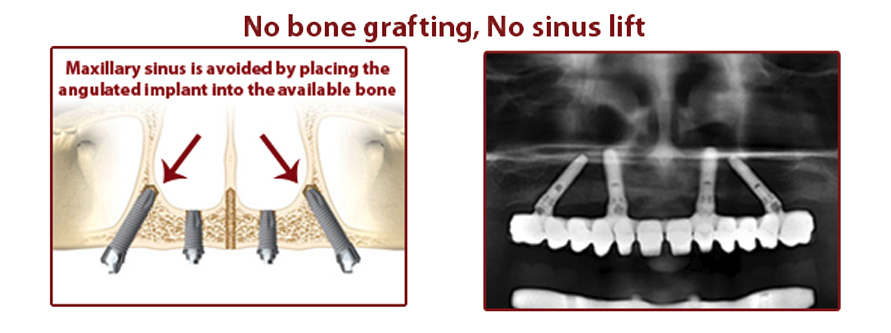 All-on-4-dental-implants-pre-op-FMS-DENTAL-Hyderabad-India
