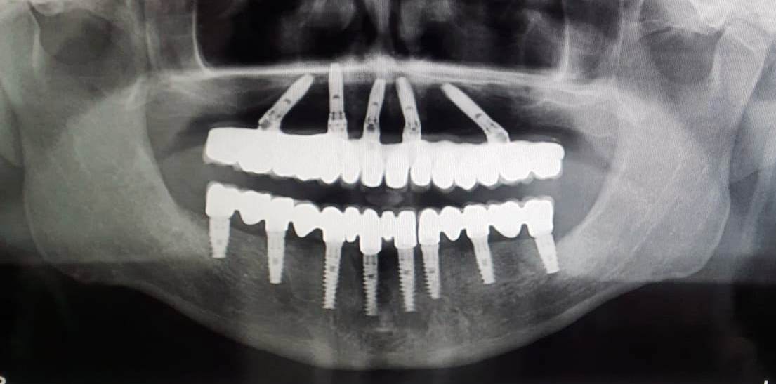 all-on-4-dental-implants-1