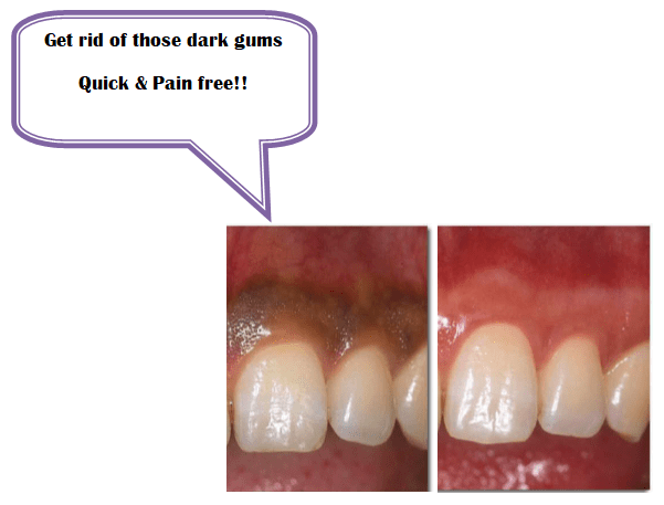 dark gums