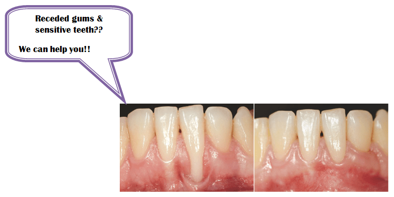 gums & sensitive teeth