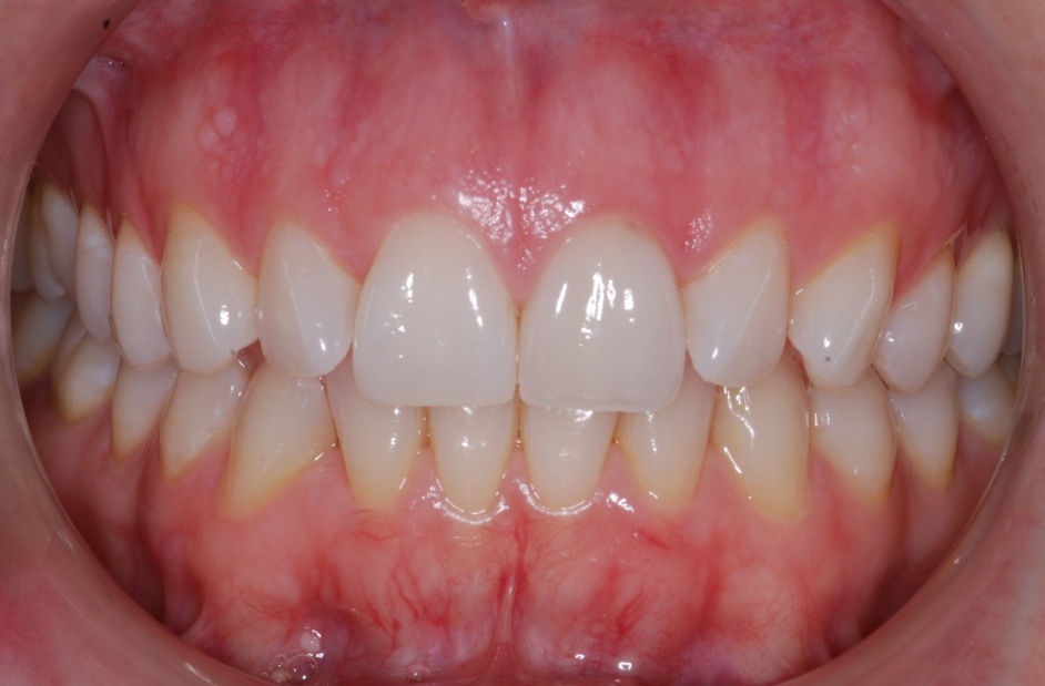 gum disease1