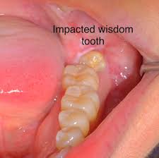 impacted wisdon tooth