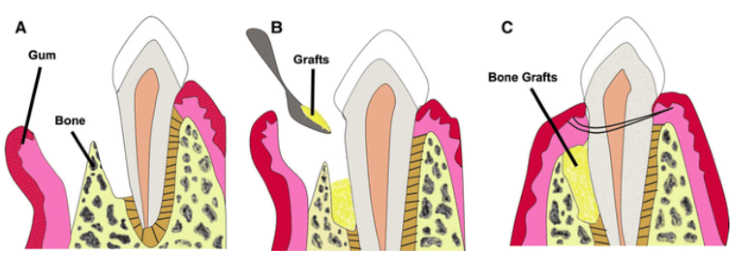 What is bone grafting.