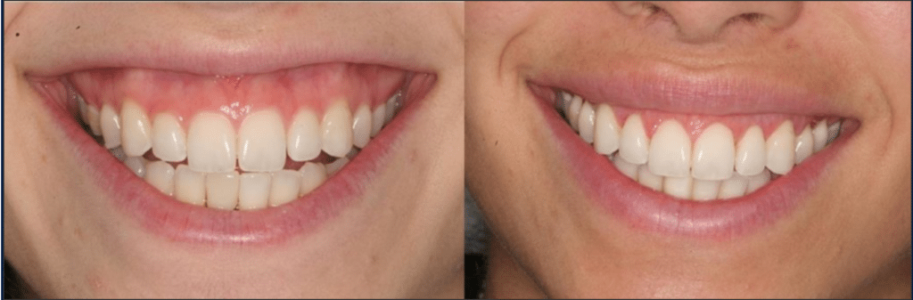 lip lengthening procedure