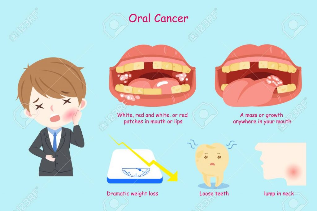 signs of Oral Cancer