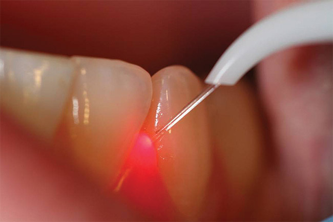 LASERs In Dentistry