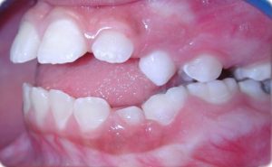 P-anterior-teeth