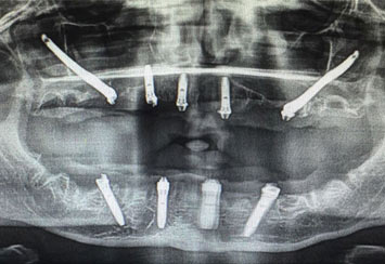 Zygomatic Dental Implant Cost In Hyderabad & Kochi