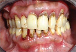 Gum disease - FMS DENTAL HOSPITAL
