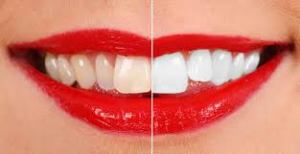 Teeth Whitening FMS DENTAL HOSPITAL