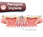 implantalptrygoid