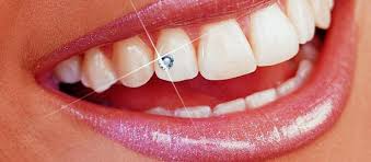 Tooth Jewellery FMS DENTAL HOSPITAL