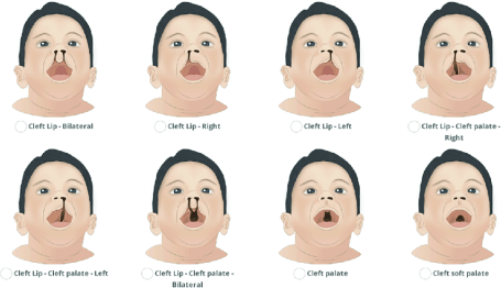 CLEFT LIP AND CLEFT PALATE