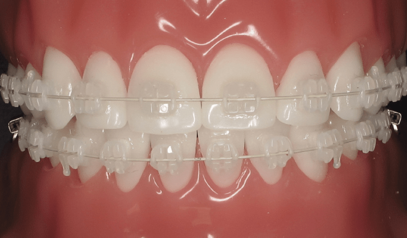 Ceramic braces FMS DENTAL