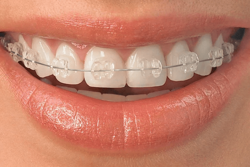 Ceramic braces FMS