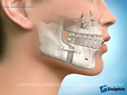 Chin surgery Genioplasty