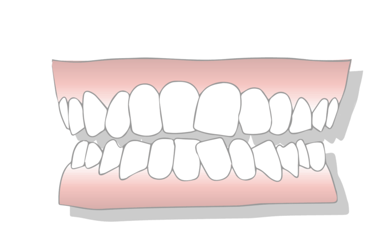 crowded teeth treatment at FMS