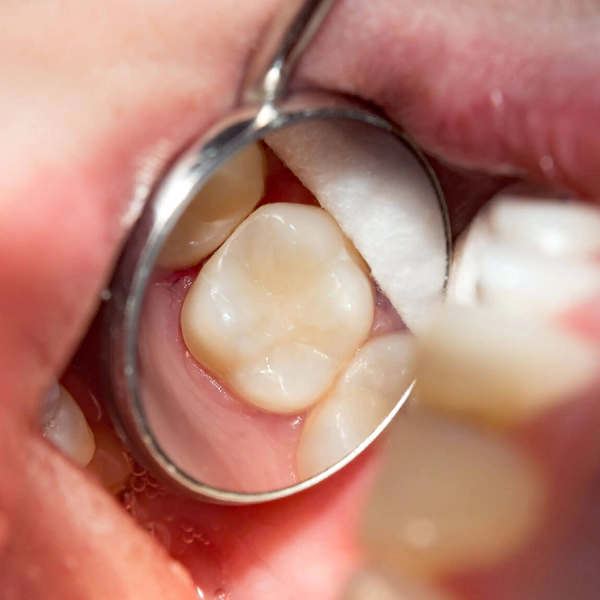 Simple fillings of the decayed teeth