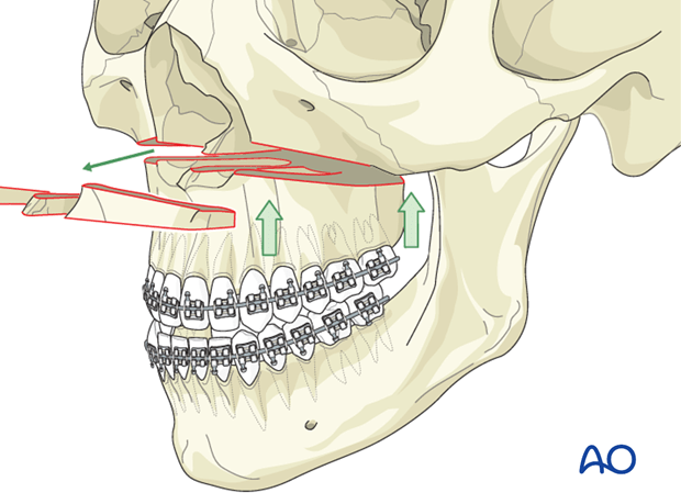 maxillary orthognathic surgery