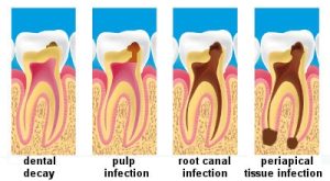 Best root canal treatment clinic in hyderabad, India