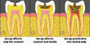 tooth decay treatment in kochi, ernakulam, kerala