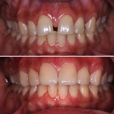 Spaces between tooth