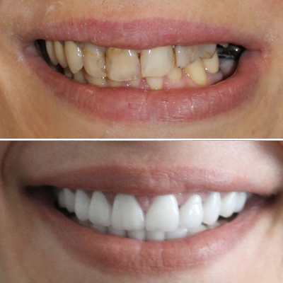 Stained or discolored teeth