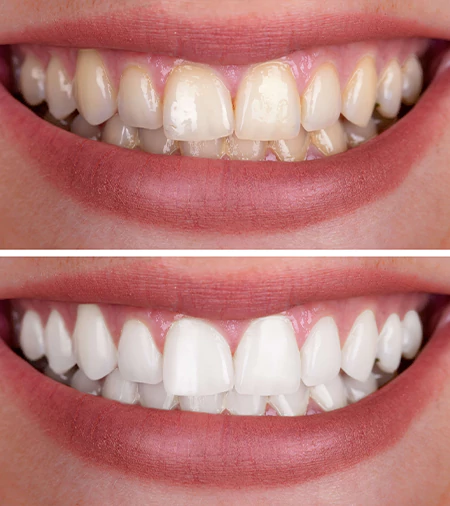 tooth whitening treatment in Hyderabad