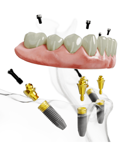 Dental Implant In Hyderabad, India