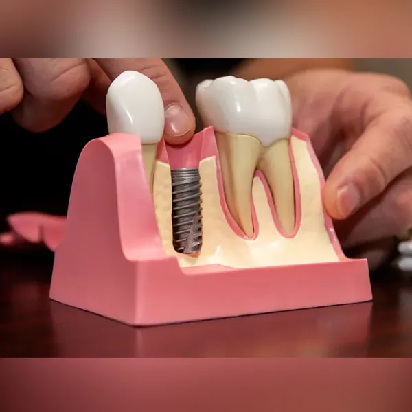 dental-implant-model