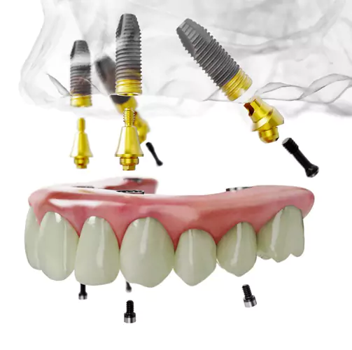 ALL-ON-4 Dental Implant