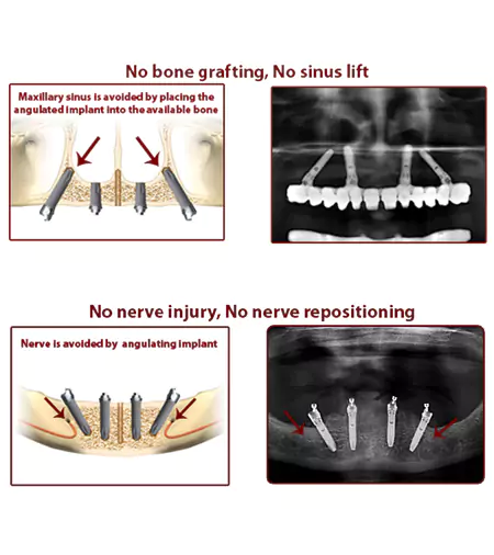 All implants procedure