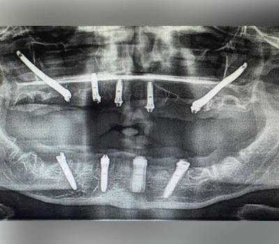 RADIOGRAPH AFTER ZYGOMA IMPLANT PLACEMENT