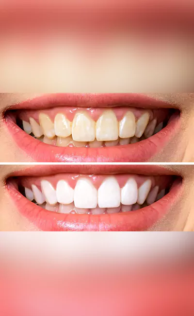 Teeth Whitening before after