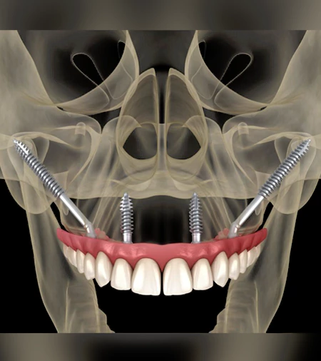The Zygomatic Implant Technique