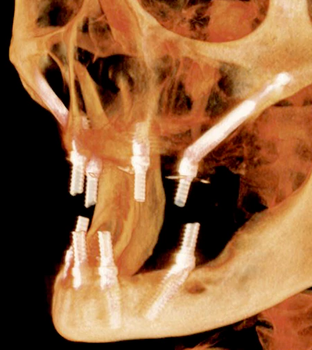 Zygomatic Dental Implants
