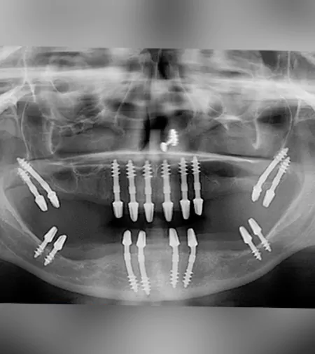 fixed teeth basal implants