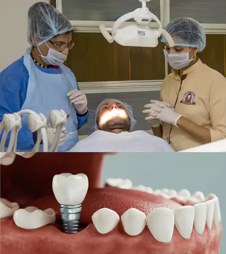 placing dental implant FNL