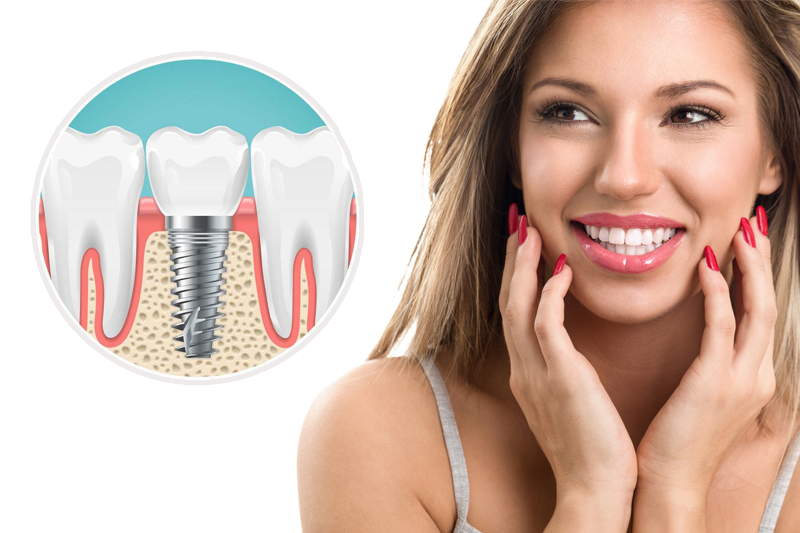 single tooth dental implant