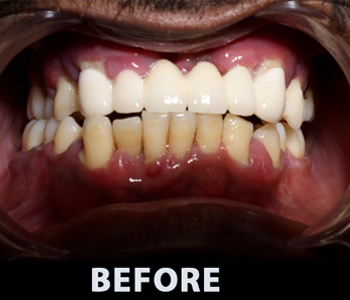 Aggressive periodontitis with Grade III mobile teeth