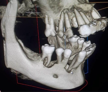CBCT right side view